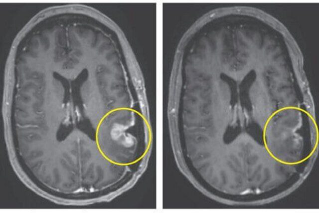 درمان تومور مغزی در طول 5 روز